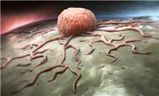 سرطان پانکراس، فعالیت متابولیک سلول‌ها را می‌دزدد!