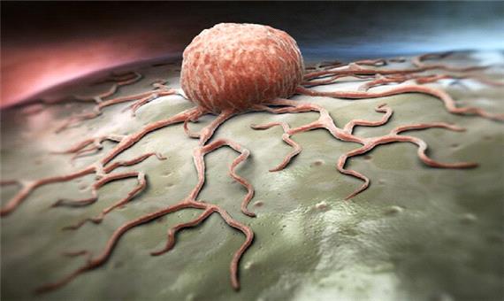 سرطان پانکراس، فعالیت متابولیک سلول‌ها را می‌دزدد!