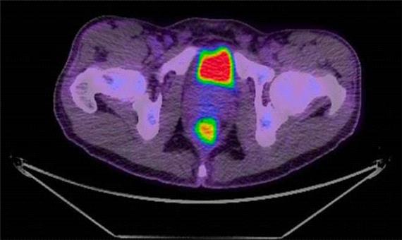 کمک به بیماران مبتلا به سرطان خون با اسکن های هوشمند PET/CT