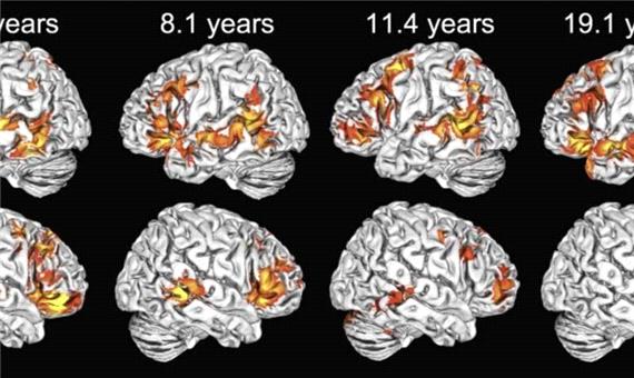 پیش‌بینی سن مغز با استفاده از روش رگرسیونی تجمیعی مبتنی بر اطلس مغزی