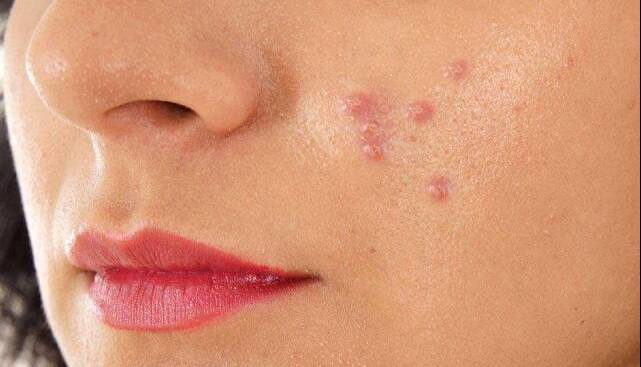 از ارتباط بین آکنه‌های پوستی با قند و شکر چه می‌دانید؟