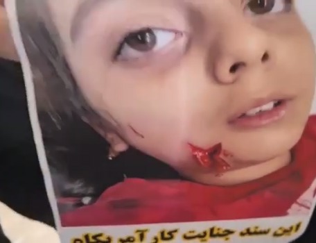 تصویر تکان‌دهنده از یک کودک خردسال بعد از اصابت ساچمه به صورتش در جنایت لامرد